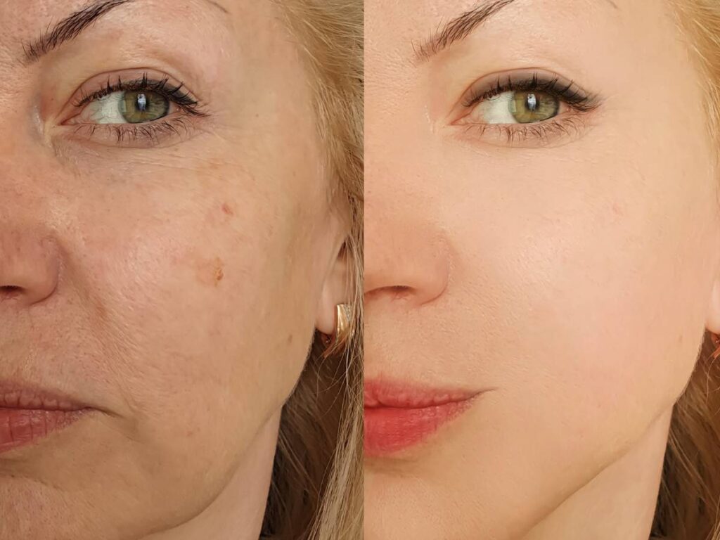 produkty na diecie po zabiegu plastycznym