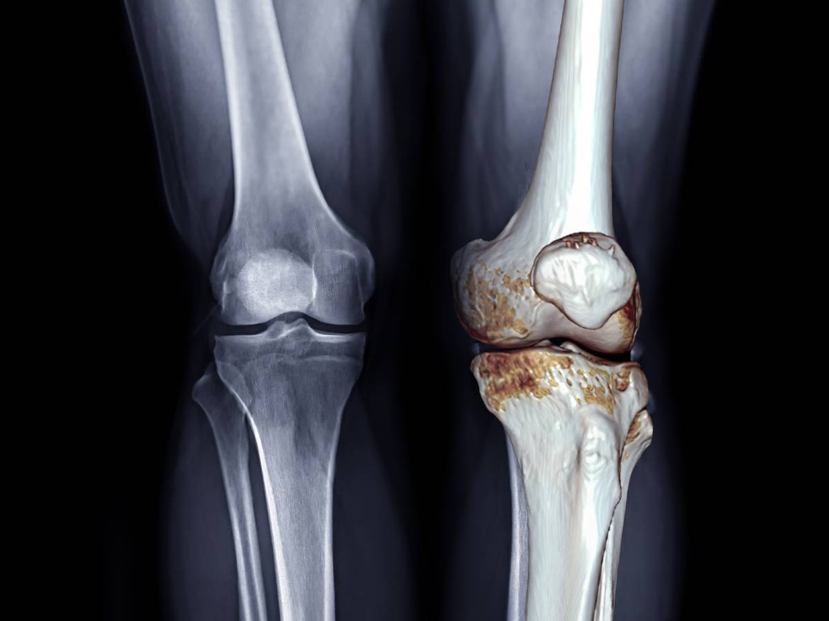 produkty na diecie przy chorobie zwyrodnieniowej stawów